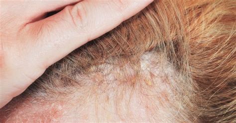  It can lead to hair loss, scaling, and secondary skin infections