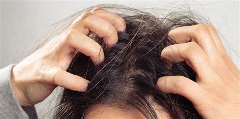  It can lead to itching, hair loss, and skin irritation