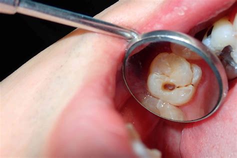  It eats away at the enamel of the teeth, causing decay and rot