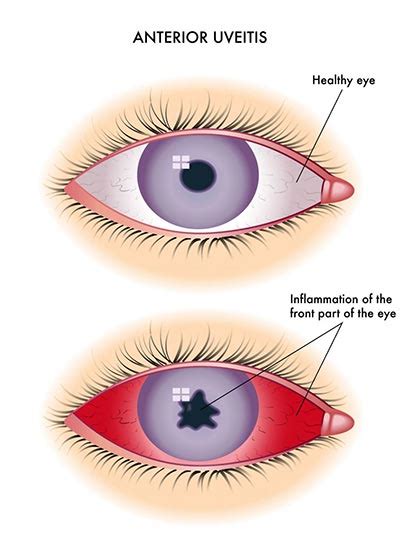  It happens when there are underlying conditions such as uveitis inflammation of the inner eye , cancer, pigmentary diseases, or displacement of the lens
