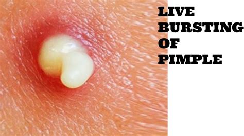  It is a clogged oil gland that seems to be a big pimple and is loaded with pus when you look at it
