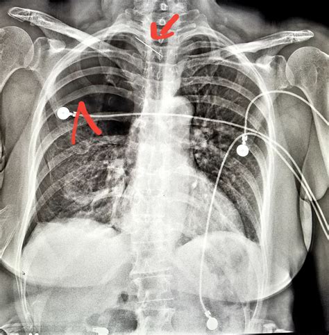  It is highly advisable to go for a routine X-ray as this might sometimes reveal a collapsed trachea