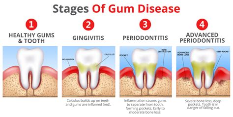  It occurs when bacteria in the mouth irritate the gums, leading to inflammation and infection