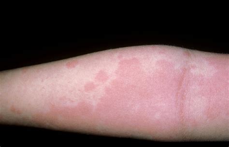  Itchy rashes are caused by inflammation of the skin