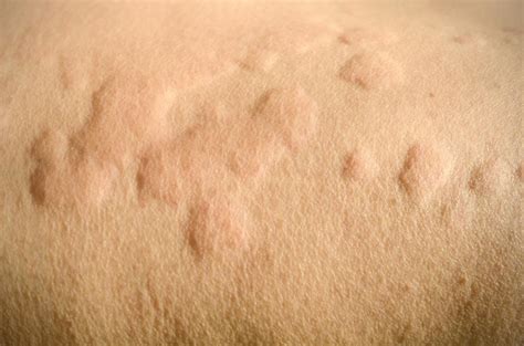 Itchy skin is usually caused by genetic, environmental, or food allergens