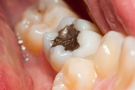  Loose, missing, cracked, or broken teeth make crunchy foods more difficult to handle