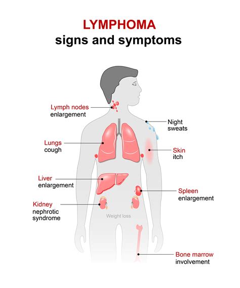 Lymphoma — a cancer of lymphocytes and lymphoid tissues which is found in places such as lymph nodes, spleen, liver, gastrointestinal tract and bone marrow