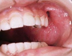  Many fibrosarcomas will become ulcerated and prone to infection