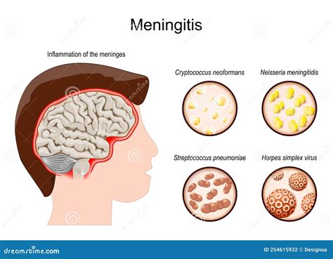  Meningitis is a condition characterized by inflammation of the meninges, which are the membranes that surround and protect the brain and spinal cord