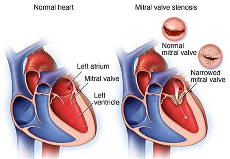  Mitral Valve Disease Mitral Valve Disease is a heart condition that affects the mitral valve, which controls blood flow between the left atrium and left ventricle of the heart
