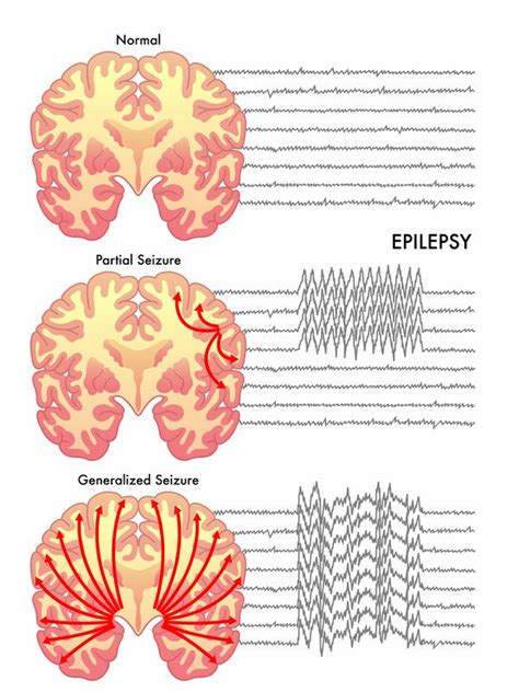  More in details, epileptic seizure frequency decreased from a mean of 8