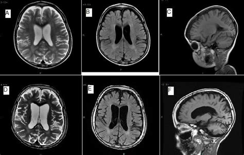  Neuronal Ceroid Lipofuscinosis: NCL is an inherited, progressive and rare neurological disorder that starts showing up between 1 and 2 years of age