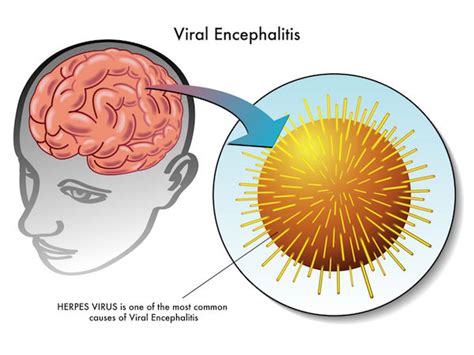  No known cause has been found for this kind of encephalitis