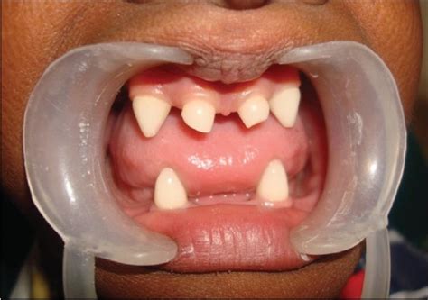  Oligodontia is a condition where only a few teeth are present