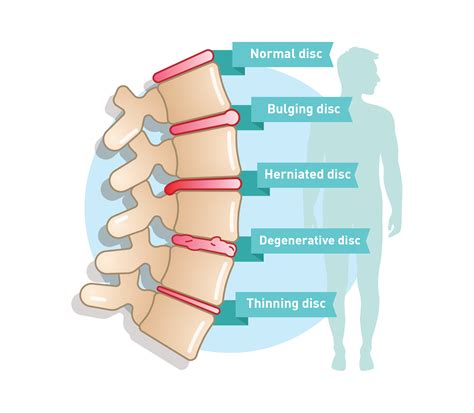  Or in more severe cases, back problems such as Intervertebral Disc Disease