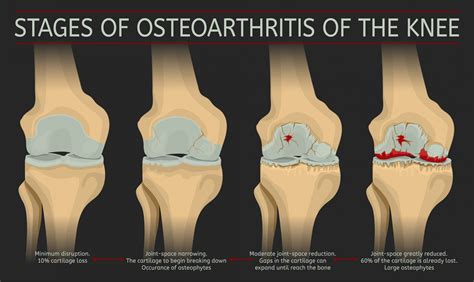  Osteoarthritis Or, when the joints begin to wear down after normal living