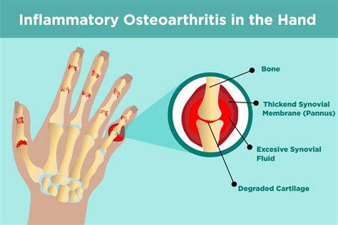 Osteoarthritis is also synonymous with degenerative arthritis