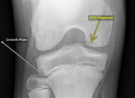  Osteochondrosis Dissecans OCD : This orthopedic condition, caused by improper growth of cartilage in the joints, usually occurs in the elbows, but it has been seen in the shoulders, as well