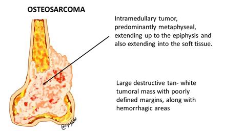  Osteosarcoma is typically easy to spot via X-ray