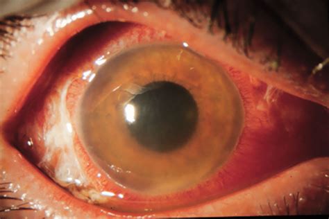  Over time, pigmentary uveitis can cause cataracts and glaucoma , which require emergency treatment
