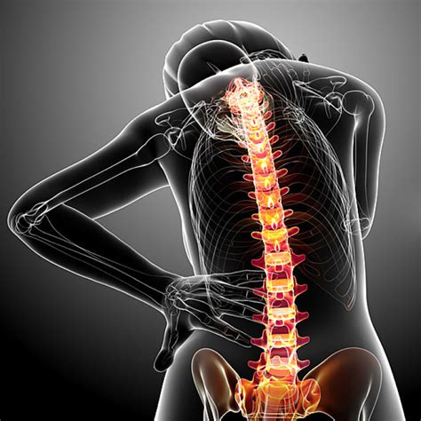  Pain from spinal cord compression can be significant and severe and difficult to control using drugs