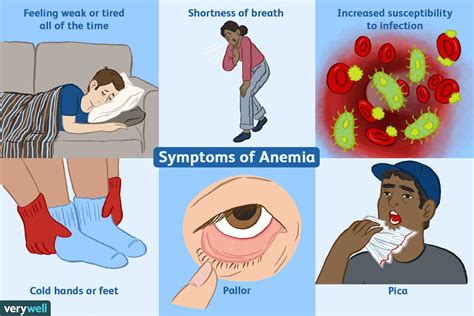  Prevention of the Anemia depends on its severity