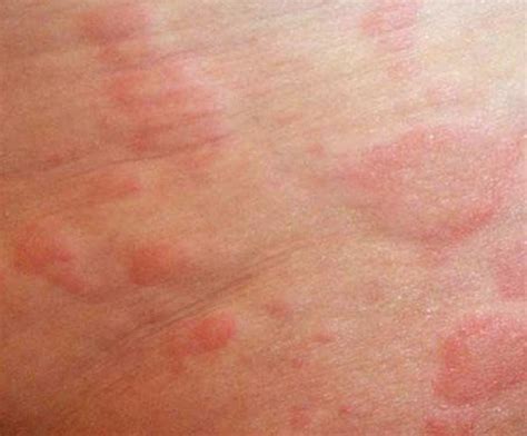  Rashes Rashes are red, itchy, irritated patches of irritated skin