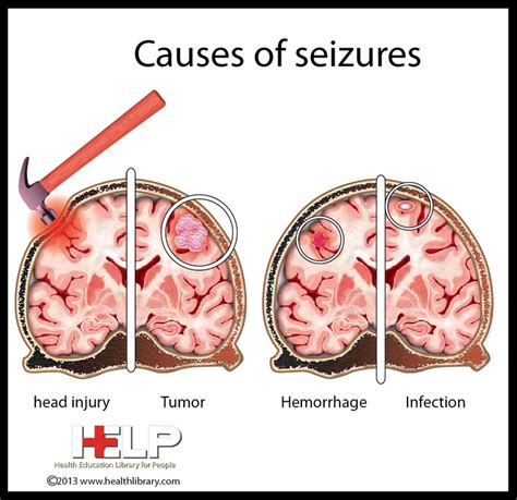  Reactive Seizures Reactive seizures are those that are caused by problems outside of the brain itself