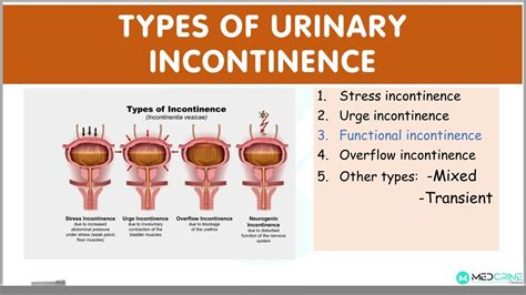  Relieving symptoms of overactive bladder and reducing urgency and frequency