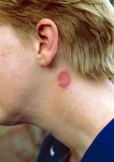  Ringworm Ringworm is a fungal infection that causes serious itch on the affected area