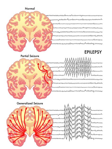  Seizures are basically caused by the abnormal firing of neurons in the brain