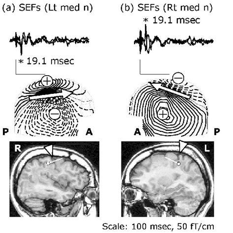  Seizures occur due to sporadic spikes in neuron activity in the victim