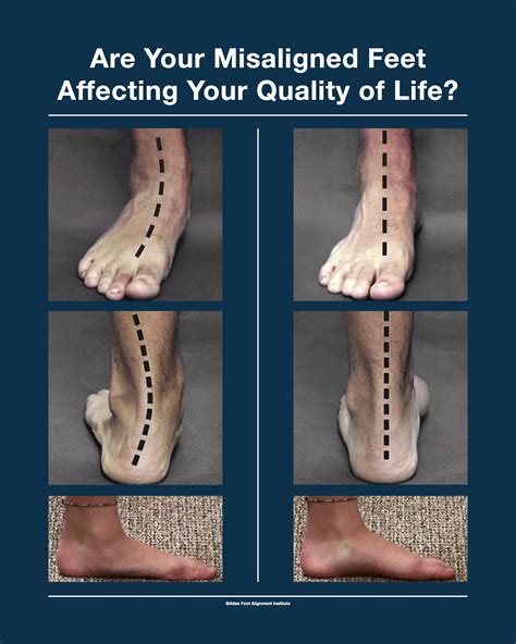  Serious Faults: Flat feet