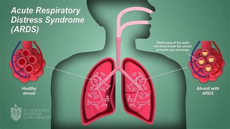  Severe cases can lead to respiratory distress and even collapse