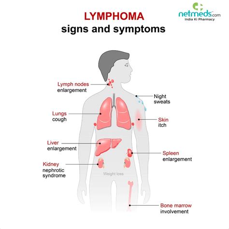  Signs of Lymphoma The largest sign of lymphoma is actually visual