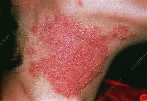  Skin Fold Dermatitis This bacterial infection happens when frictional trauma around the folds eventually causes inflammation or bacterial growth