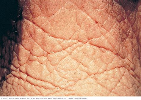  Skin Infections: Those charming face wrinkles can trap bits of food and moisture so gross! Bacteria can multiply there, leading to skin infections