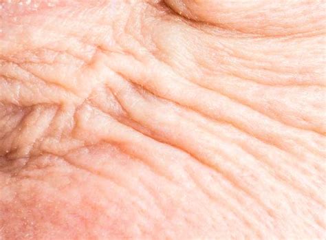  Skin infections are also a concern do to the wrinkly and folds nature of the skin