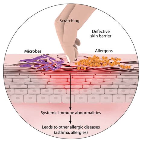  Skin or blood tests will reveal the specific airborne allergens that cause atopic dermatitis