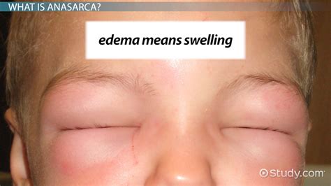  Some Findings on Causes still not proven Congenital anasarca congenital generalized subcutaneous edema