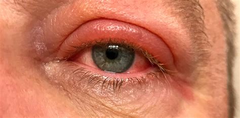  Some common inherited conditions that can cause red eyes include entropion, which is a condition in which the eyelid rolls inwards, and cherry eye, in which the third eyelid slips out of place and causes the eye to become red and irritated