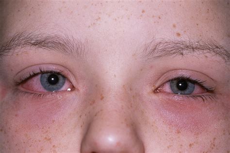  Sometimes allergic reactions are also accompanied by red or watery eyes or sneezing
