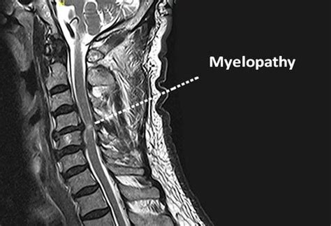  Spinal Issues: Degenerative myelopathy DM is often genetic in nature and affects the spinal cord, leading to weakness and hind limb paralysis