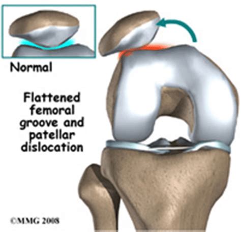  Surgery to deepen the groove the patella sits in is an extremely effective way of treating this condition