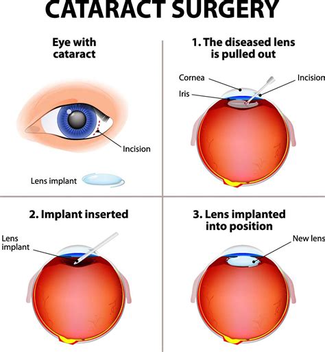  Surgery to remove cataracts and restore sight may also be an option