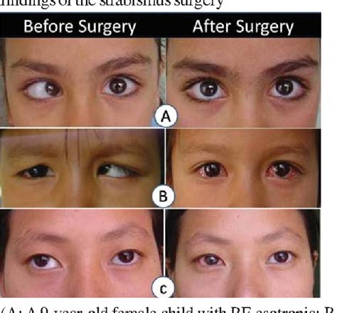  Surgical correction is usually successful if performed early