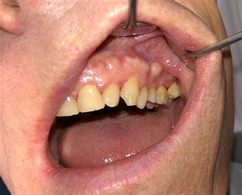  Surgical removal is the standard method, but it can cause significant setbacks and difficulties depending on how much mouth and jaw tissue is removed
