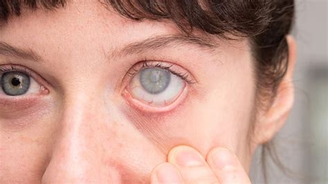  Symptoms: milky or cloudy look to the eyes, grayish film, noticeable vision loss, clumsiness