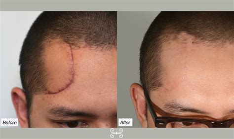  Take into consideration that scars from injury or surgery can come in with gray hairs, in which case you can rule that out as a sign of aging