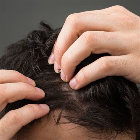  That can lead to temporary hair loss, and in some extreme circumstances, some patchy permanent loss